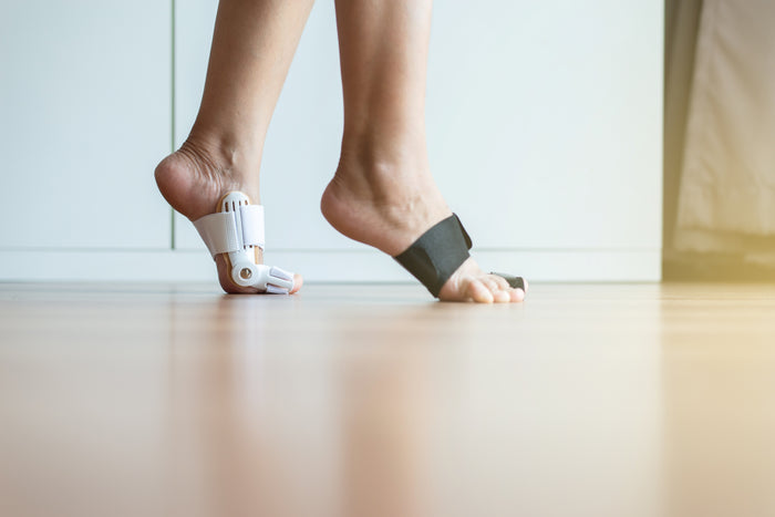 How Long Should You Wear a Bunion Splint or Corrector?