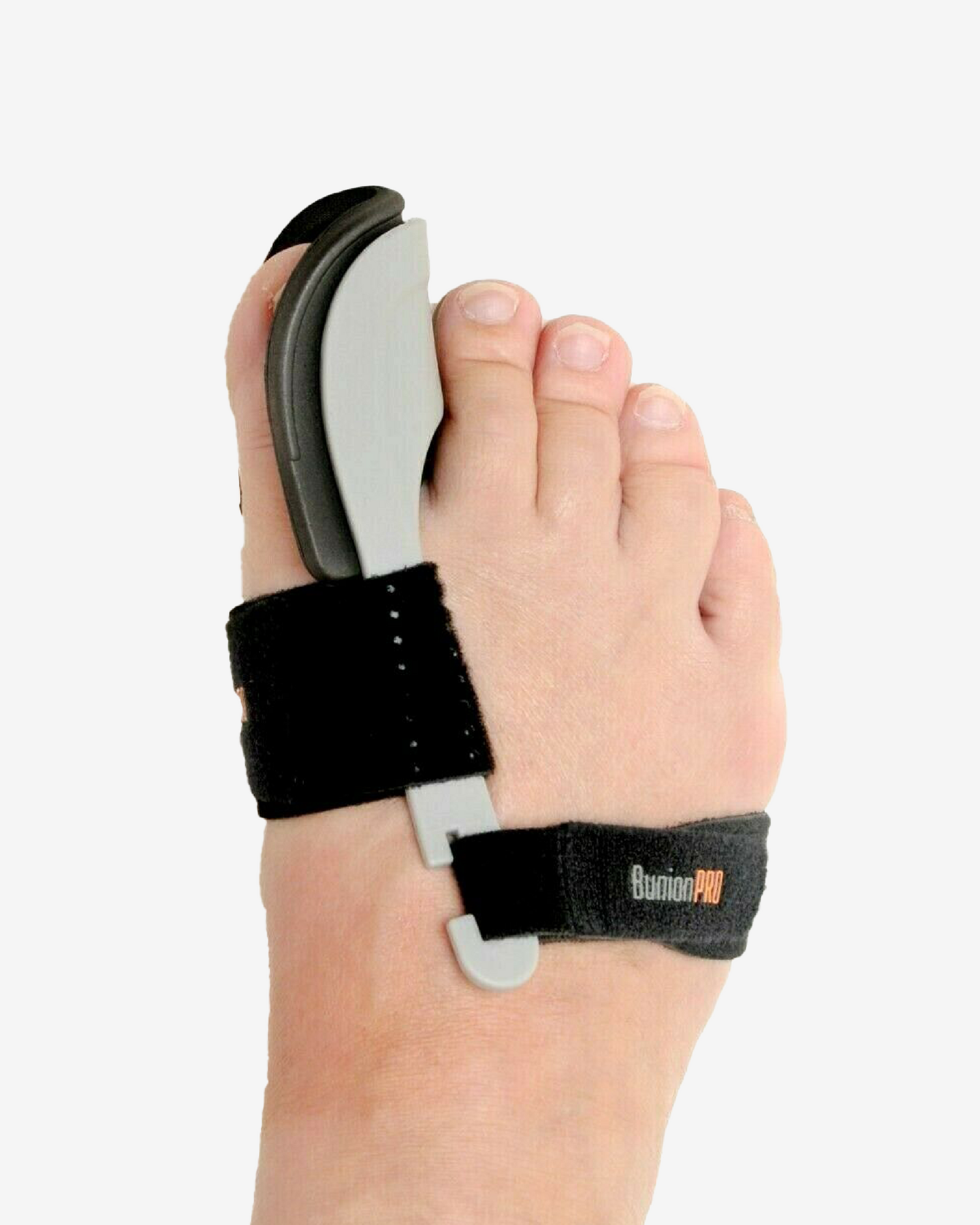 Can You Correct a Bunion Without Surgery?