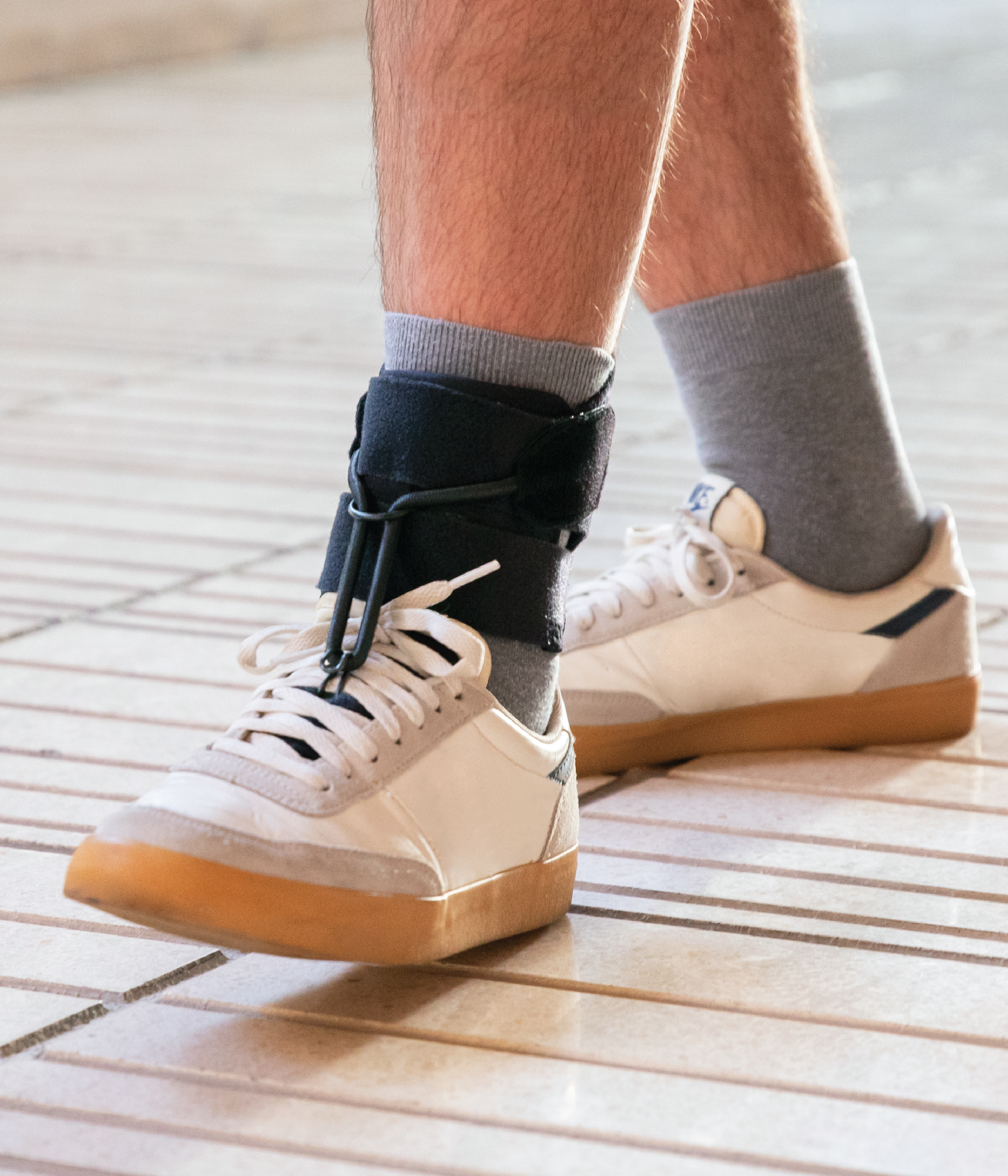 What Is Foot Drop?