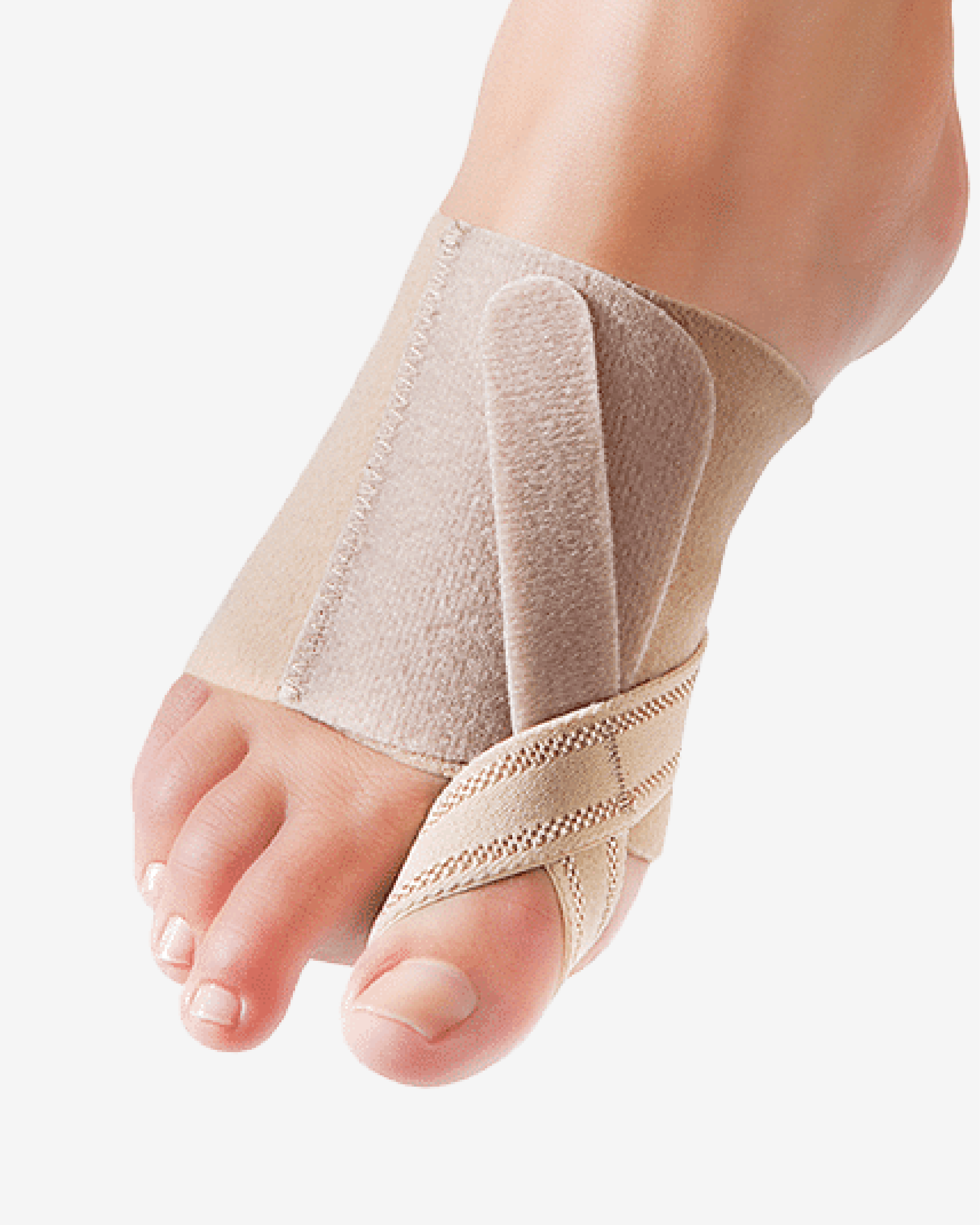 Conex® Hallux Valgus Correction