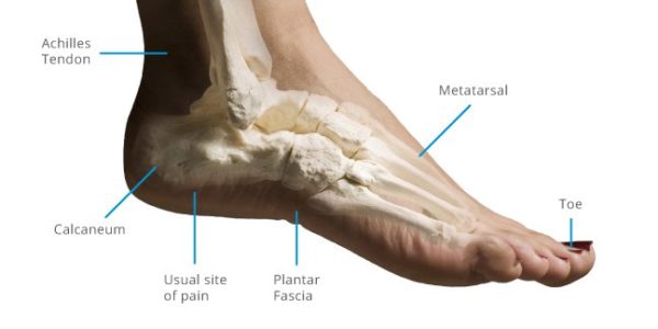 What Is Plantar Fasciitis? - Orthotix